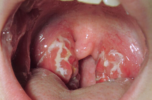 white spots on tonsils